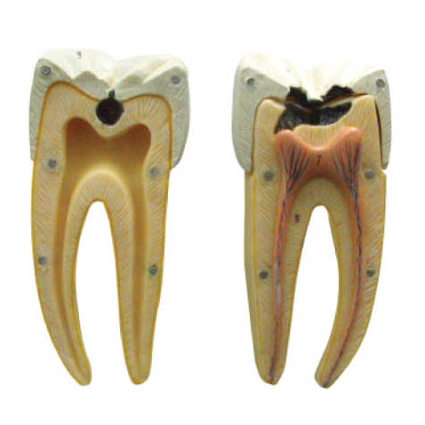 Dental Caries Model